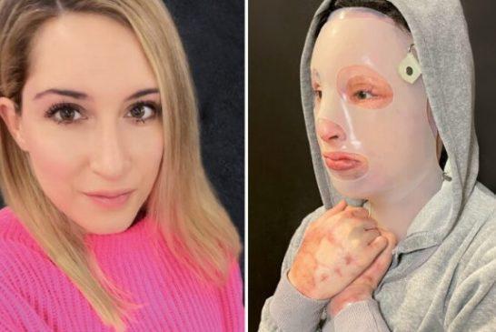Ιωάννα Παλιοσπύρου: Δημοσίευσε για πρώτη φορά φωτογραφίες από το χειρουργείο μετά την επίθεση με το βιτριόλι
