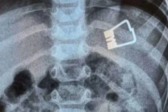 Αγοράκι δυο ετών κατάπιε μανταλάκι στη Λήμνο – Πώς το έσωσαν γιατροί χωρίς χειρουργείο